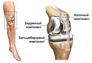 Прегледи на лекарите и пациентите за артропластика на коляното