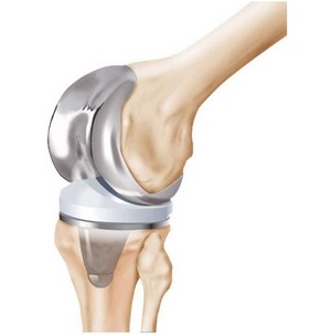 Прегледи на лекарите и пациентите за артропластика на коляното
