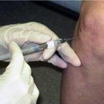 Интраартикуларно инжектиране в коленните и тазобедрените стави: техниката на инжекциите, преглед на лекарствата