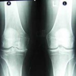 Анестетични мехлеми за остеоартрит на коляното