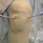 Артроскопия на колянната става: възстановяване на коляното след операция