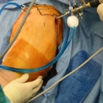 Артроскопия на раменната става: рехабилитация след операция, обратна връзка за възстановяване