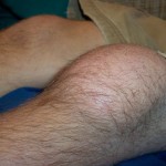Бурсит маз: лечение на раменните и коленните стави