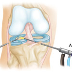 Последици след артроскопия на коляното: болка в корема и коляното