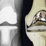 Ендопротези на коляното: снимки на колянната ендопротеза, прегледи за протезата (общо и ревизия)