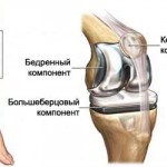 Ендопротези на коляното: снимки на колянната ендопротеза, прегледи за протезата (общо и ревизия)
