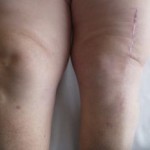 Ендопротезиране на колянната става: рехабилитация след операция, усложнения