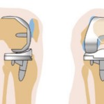 Ендопротезиране на колянната става: рехабилитация след операция, усложнения