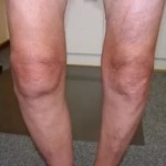 Упражнения за ставите на краката: комплекс за пациентите на коленете