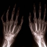 Народни средства за лечение на ревматоиден артрит: преглед на методите