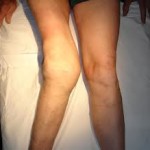Гонартроза на колянната става от 2-ра степен: лечение с народни средства