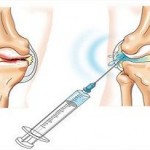 Препарати от хиалуронова киселина за колянната става: преглед на инжекциите на коляното, прегледи на инжекциите