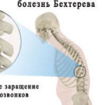 Масаж с болестта на Бехтерев: Видео гимнастика за гърба