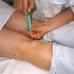 Работа по киста на Бейкър: отстраняване и пробиване на колянната става