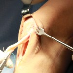 Работа по колянни стави: разкъсване на колянните връзки