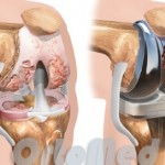 Операция за подмяна на коляното: какво е това, цената на протезата, снимките (преди и след)