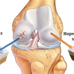 Остеоартрит на колянната става: лечение с народни средства