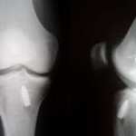 Пластмаси на предния кръстосан лигамент на колянната става