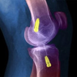 Пластмаси на предния кръстосан лигамент на колянната става