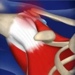 Синдром на рамото-скополи: симптоми и лечение на периартрит