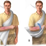 Кожухана (косиноная) превръзка върху рамото: как да се наложи на рамото