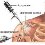 Хирургия на раменната става: хирургично лечение на рамото (артроскопия)