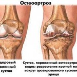Лечение на остеопороза на коляното с народни средства: методи на лечение