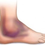 Лечение на навяхването на глезенната става у дома с народни средства: как да се лекуват сухожилията на крака