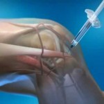 Лечение с артрози на колянната става: преглед на лекарствата за коляното, лекарства в таблетки и капсули