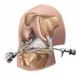 Какво е артроскопска санитария на колянната става: прегледи за анатомична артроскопия