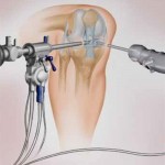 Какво представлява артроскопията на коляното: преглед на операцията на коляното