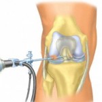 Какво представлява артроскопията на коляното: преглед на операцията на коляното