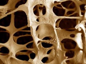 Как да приемате Ostegenone за лечение на остеопороза и други заболявания