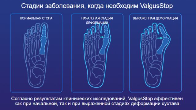 Крем ValgusStop - ефективен метод за лечение на валгус деформация на крака