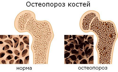 Ефективността на остеоген в лечението на остеопороза