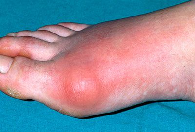 Как е възпалението на ставата на крака и неговото лечение?
