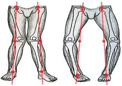 Как да облекчите възпалението в колянната става и нейните причини