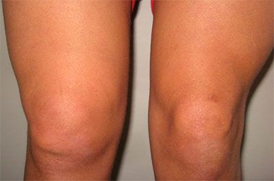 Как да облекчите възпалението в колянната става и нейните причини