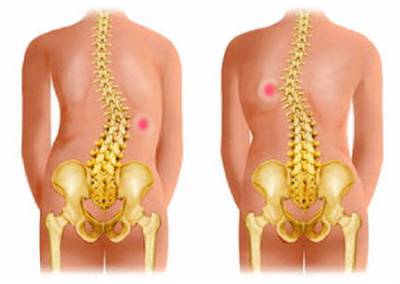 Ортопедични корсети за гръб и техните видове