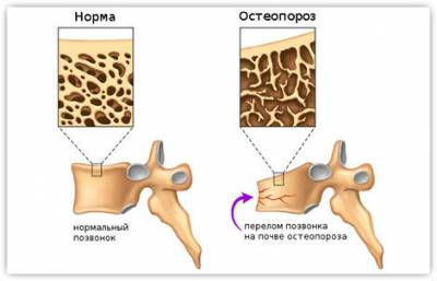 Основните причини за остеопорозата