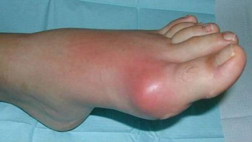 Най-често срещаните заболявания на ставите на краката