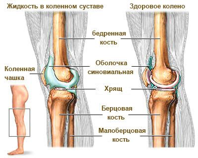 Натрупване на течност в колянната става