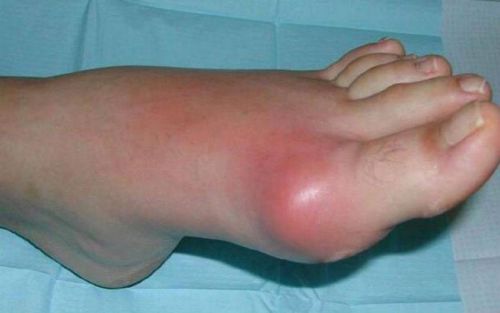 Най-често срещаните заболявания на ставите на краката
