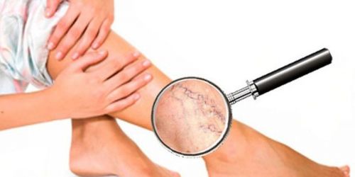 Масаж на коляното с артроза