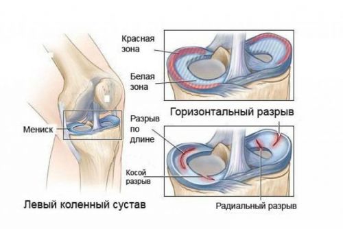 Рехабилитация след операция на менискуса на колянната става