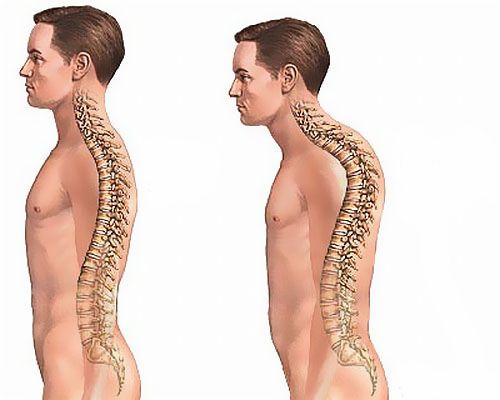 Последици от компресионната фрактура на гръбначния стълб