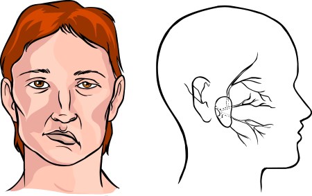 Твърдост на тилната мускулатура - какви са причините, симптомите, лечението