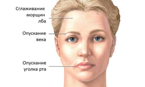 Пареза на лицевия нерв: възможни причини, симптоми и характеристики на лечението