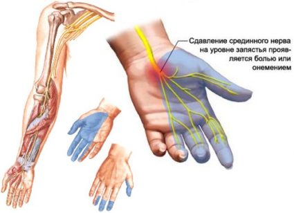 Причини за изтръпване на пръстите и пръстите на краката