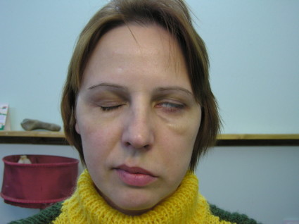 Невралгия: интеркостален, постхерпетичен, лицев нерв